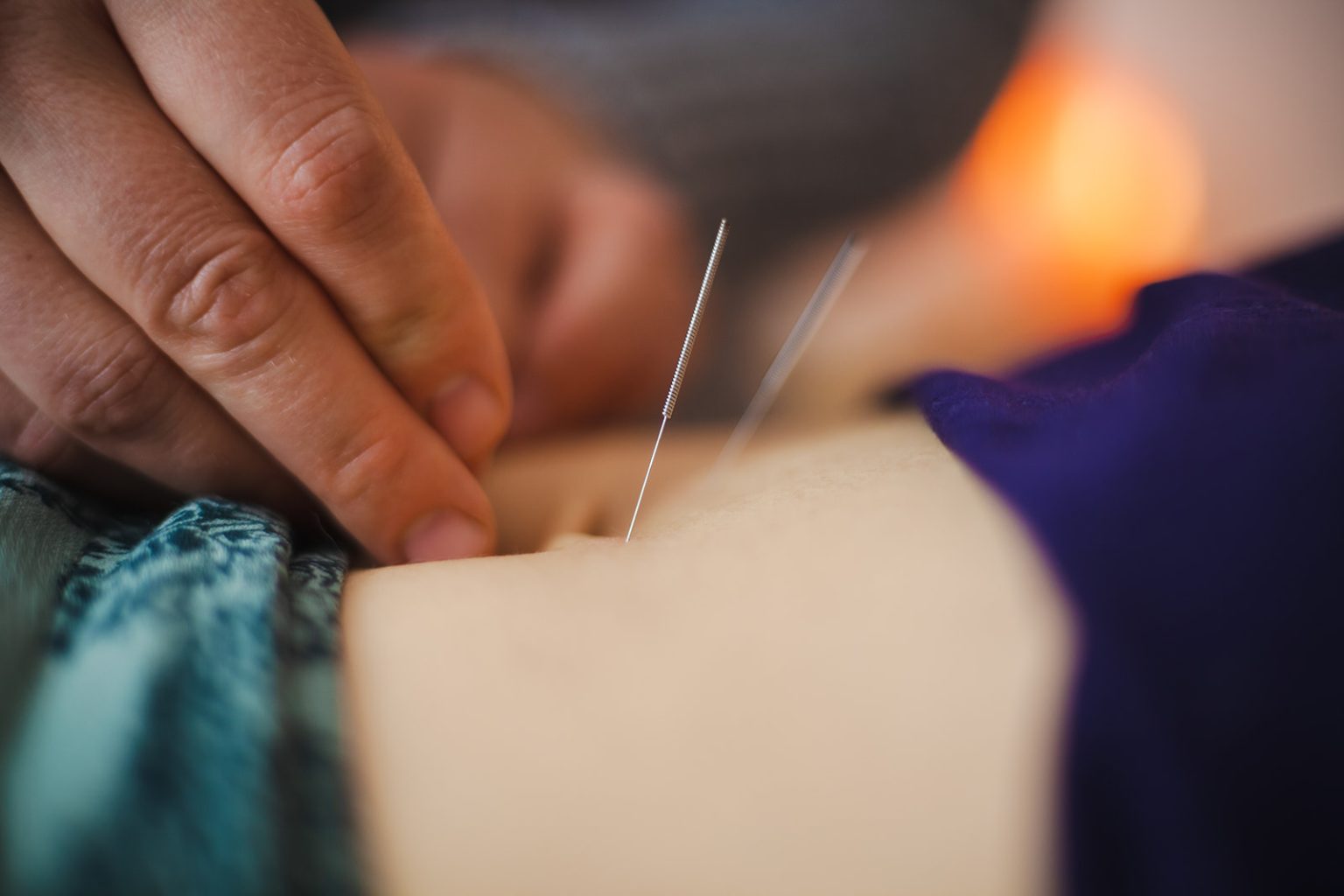 Akupunktio