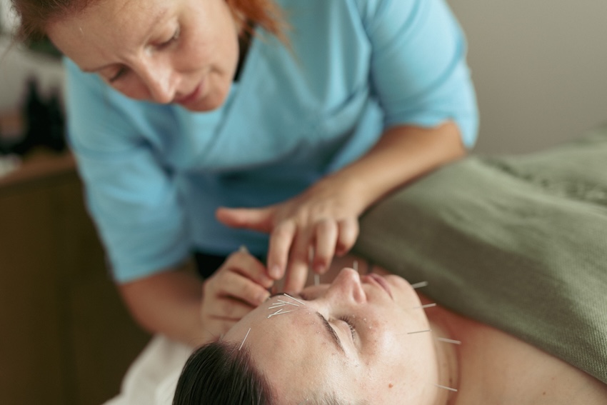 Kosmeettinen akupunktio